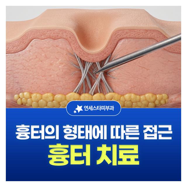 흉터 치료, 흉터의 형태에 따른 접근 치료 골든타임을 놓치지마세요